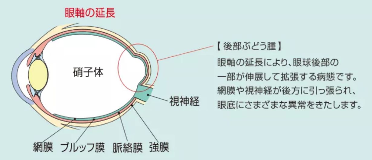 近視性脈絡膜新生血管（脈絡膜新生血管）とは