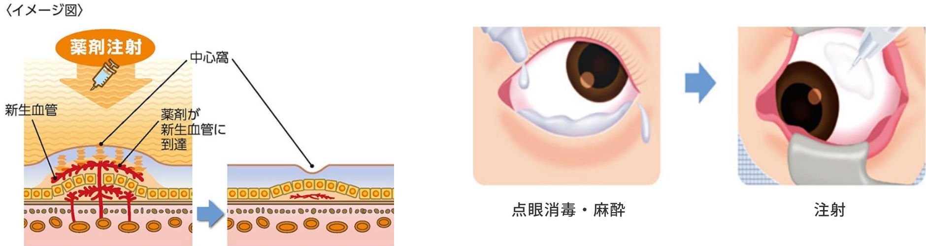 黄斑疾患の治療方法