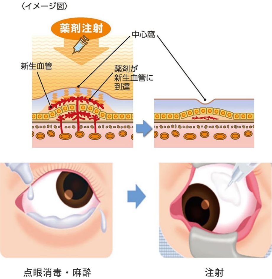 黄斑疾患の治療方法