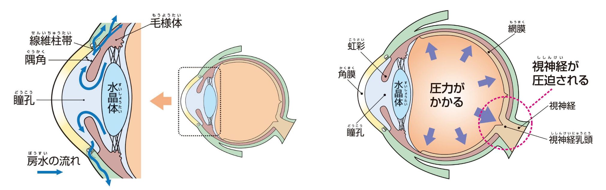 緑内障について