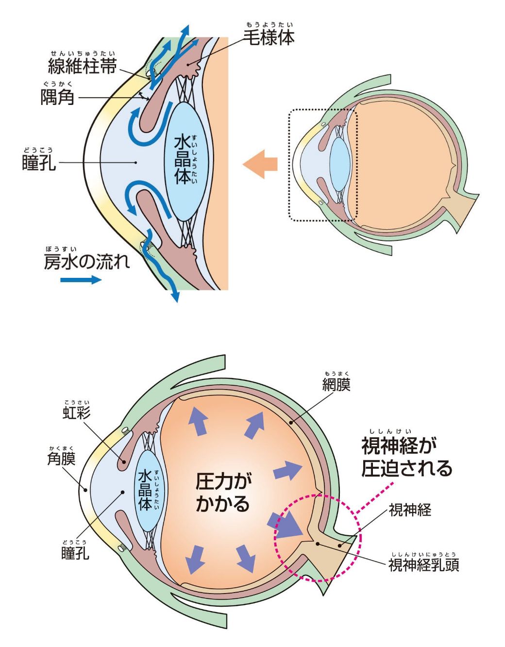 緑内障について