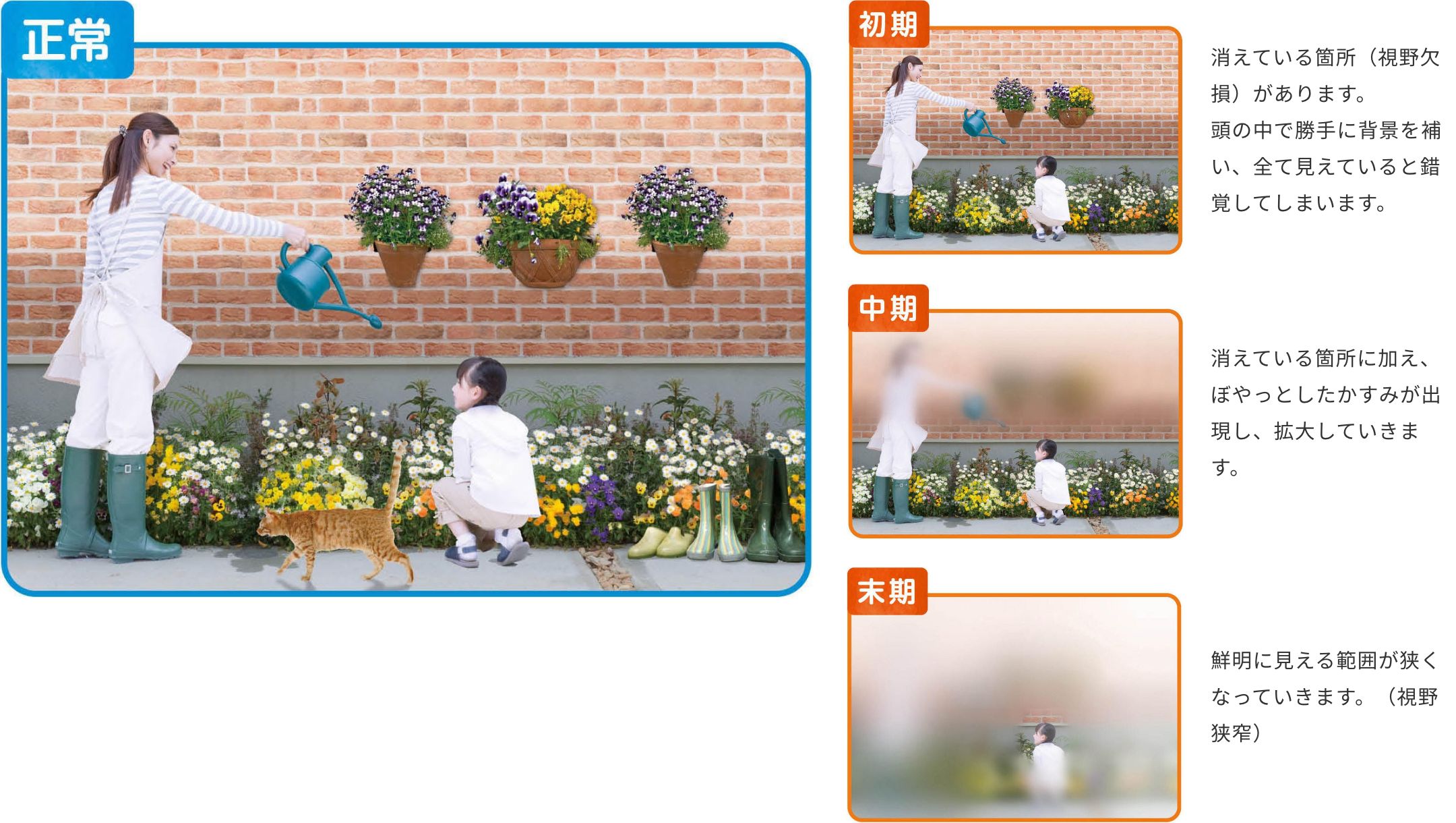 緑内障について