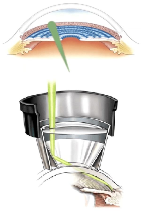 SLT（隅角光凝固術）