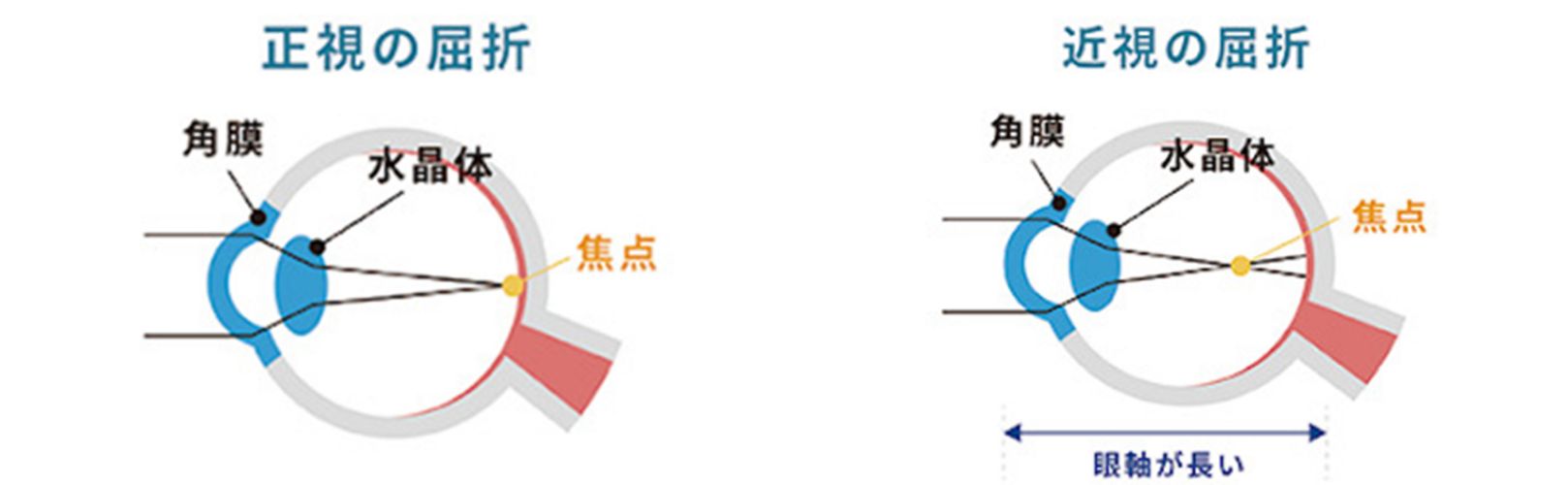 近視進行抑制治療
