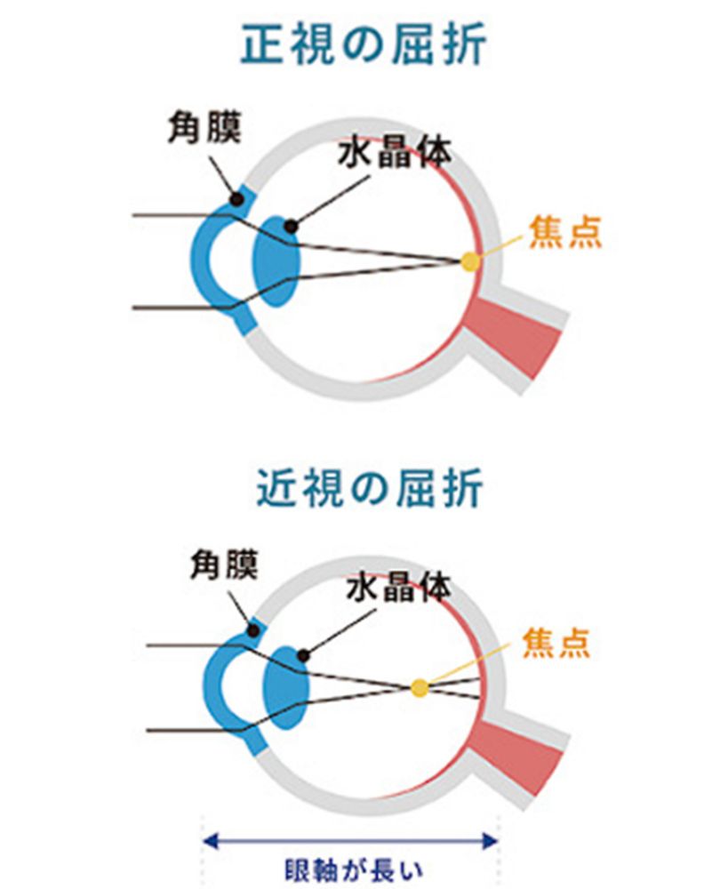 近視進行抑制治療
